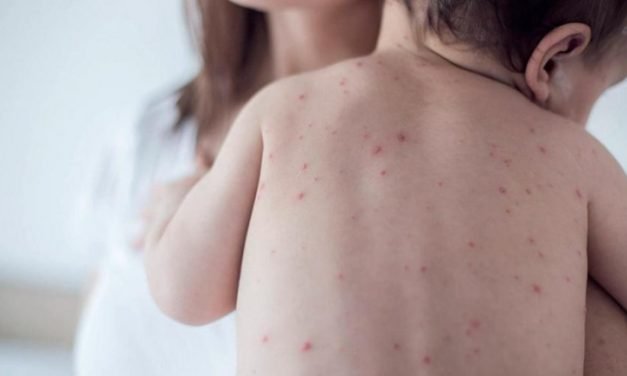 Alerta por casos de sarampión